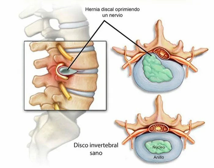 Tratamiento Hernias de Disco - Isomedic