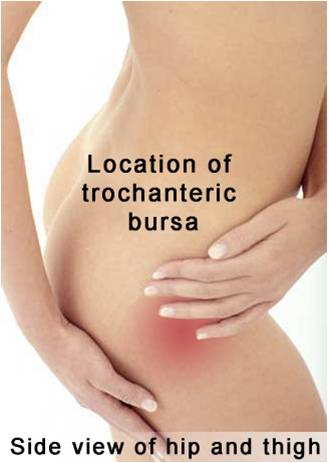 Tratamiento para Bursitis Trocantérea