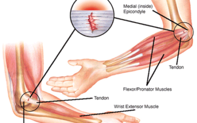 Tratamiento Epicondilitis