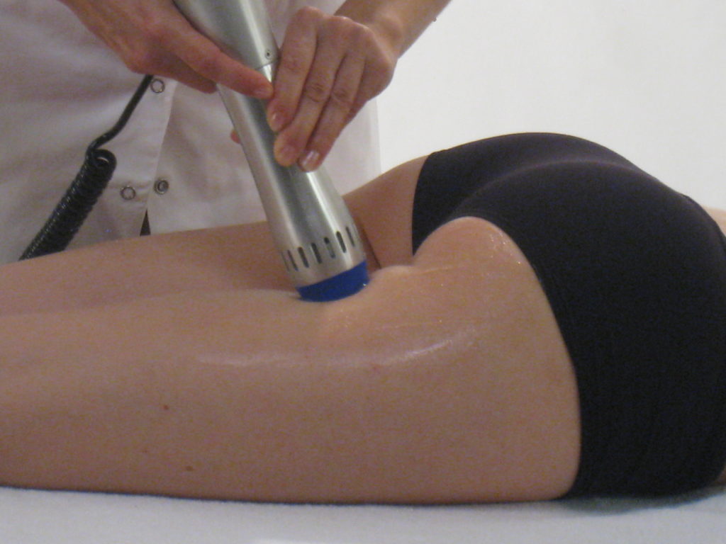 eliminación de estrías,ondas de choque celulitis